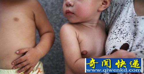 广州一岁半女婴乳房发育如少女 性早熟【图讯】