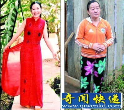 23岁阮女士患奇异怪病 3年皮肤衰老成90岁老太