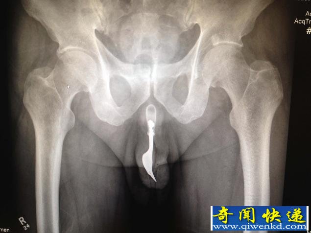 加拿大男为追求性快感将叉子插进阴茎 送往医院抢救