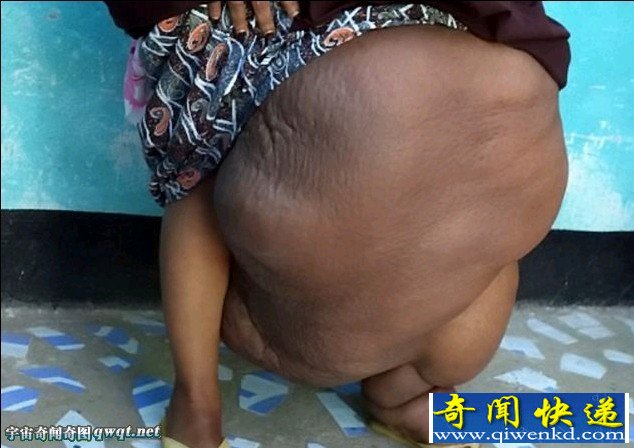 索马里女子阿布迪努尔患象皮病 左腿粗如象腿重达32公斤