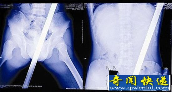 男子惨被150公分钢筋插入下体 太残忍了!
