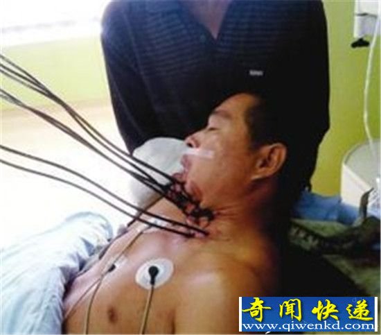 男子惨被150公分钢筋插入下体 太残忍了!