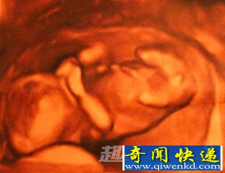 试管婴儿诞生