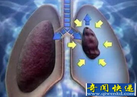 女子做针灸扎破肺:做针灸竟被扎破肺 小命差点不保