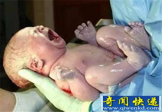 婴儿手握避孕环出生:想弄死我?没那么容易!