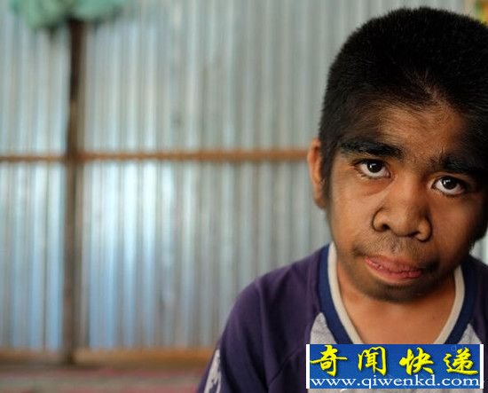 印尼狼孩自认被神选中 拒绝接受治疗