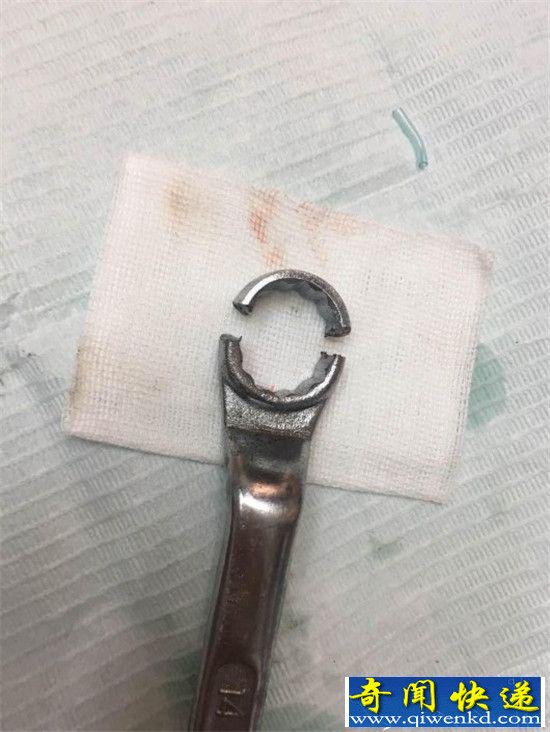 男子下体被扳手套住17小时 最终被口腔科医生拯救