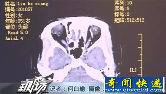 50岁女子喝3斤白酒脑死亡