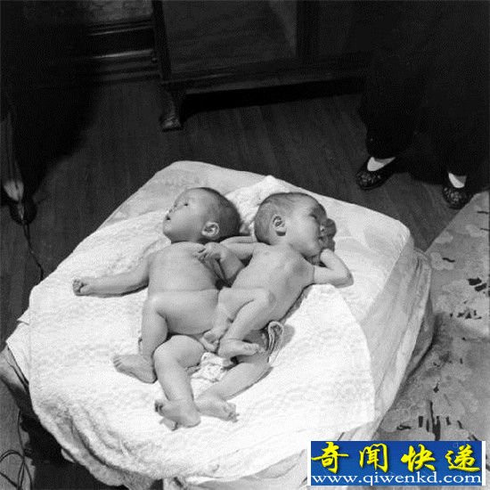 揭秘:上海1947年连体婴 竟然被如此处理