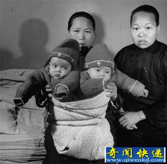 揭秘:上海1947年连体婴 竟然被如此处理