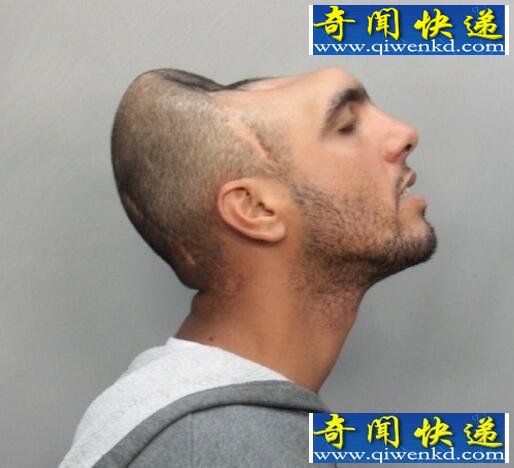 脑袋只有一半的半脑哥,揭秘半脑哥存活的原因