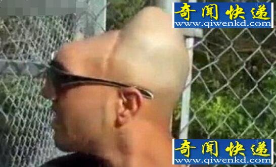 脑袋只有一半的半脑哥,揭秘半脑哥存活的原因