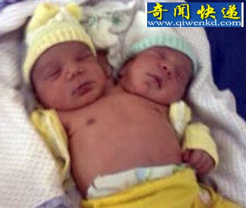 巴西双头婴儿诞生,两个头颅共用一个身体