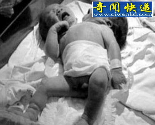 巴西双头婴儿诞生,两个头颅共用一个身体